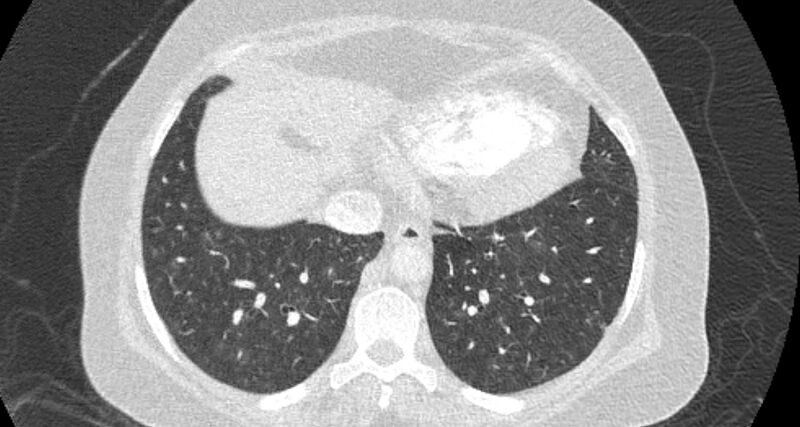File:Accessory right inferior hepatic vein (Radiopaedia 65245-74259 Axial lung window 58).jpg