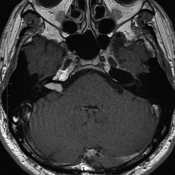 File:Acoustic schwannoma - intracanalicular (Radiopaedia 9937-10504 Axial T1 C+ 1).jpg