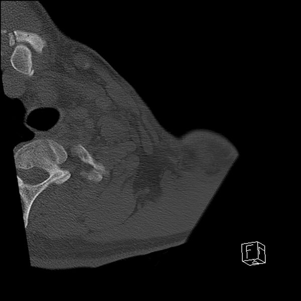 File:Acromioclavicular joint dissociation - type IV (Radiopaedia 64411-73216 Axial bone window 1).jpg