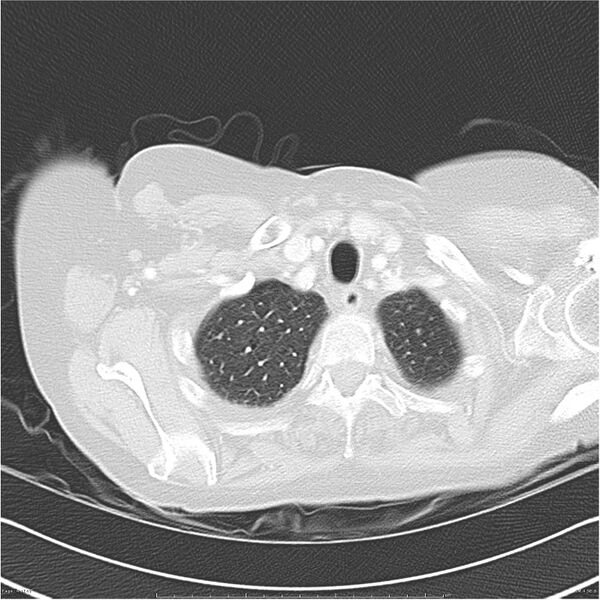 File:Acute-on-chronic pulmonary emboli (Radiopaedia 27925-28169 lung window 4).jpg