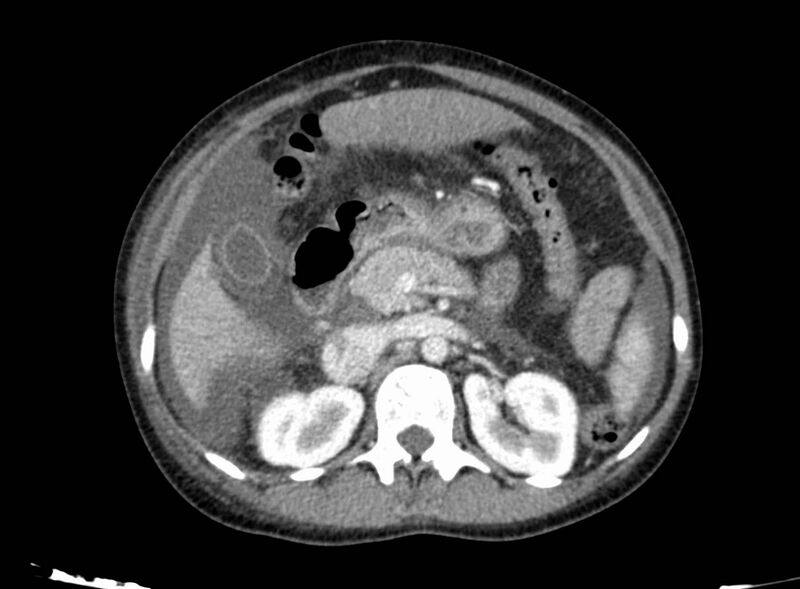 File:Acute Budd-Chiari syndrome (Radiopaedia 60858-68638 Axial C+ portal venous phase 114).jpg