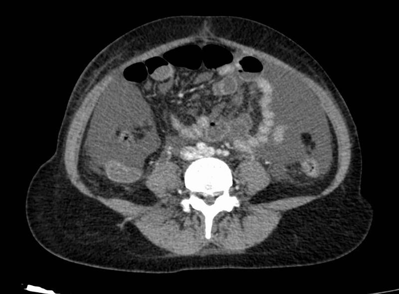 File:Acute Budd-Chiari syndrome (Radiopaedia 60858-68638 Axial C+ portal venous phase 190).jpg