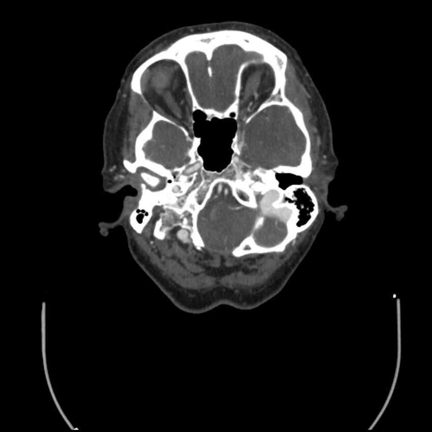 Acute M1 occlusion with ischemic penumbra (CT perfusion) (Radiopaedia 71897-82344 Axial C+ arterial phase thins 129).jpg