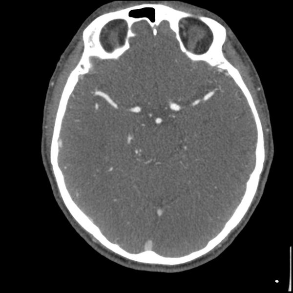 File:Acute P1 occlusion with PCA ischemia penumbra (CT perfusion) (Radiopaedia 72084-82587 Axial C+ arterial thins 40).jpg
