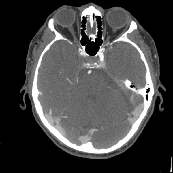 File:Acute P1 occlusion with PCA ischemia penumbra (CT perfusion) (Radiopaedia 72084-82587 Axial C+ arterial thins 64).jpg