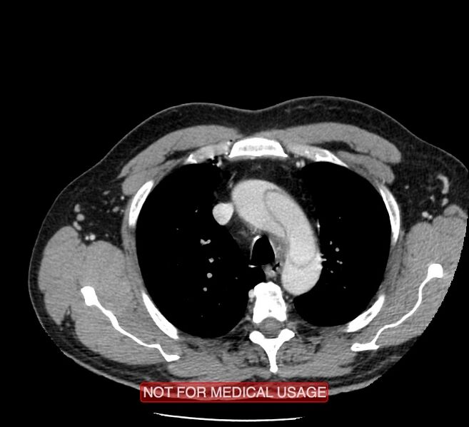 File:Acute aortic dissection - Stanford type A (Radiopaedia 40661-43285 Axial C+ portal venous phase 4).jpg