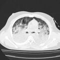 Acute aspiration pneumonitis (Radiopaedia 33605-34703 Axial lung window 44).jpg