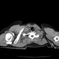 Acute aspiration pneumonitis (Radiopaedia 33605-34703 Axial non-contrast 16).jpg