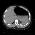Acute aspiration pneumonitis (Radiopaedia 33605-34703 Axial non-contrast 77).jpg
