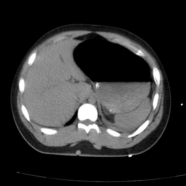 File:Acute aspiration pneumonitis (Radiopaedia 33605-34703 Axial non-contrast 77).jpg