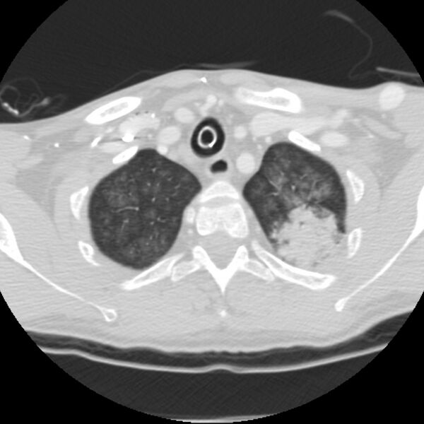 File:Acute diffuse alveolar hemorrhage (Radiopaedia 41323-44158 Axial lung window 4).jpg