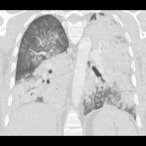 File:Acute diffuse alveolar hemorrhage (Radiopaedia 41323-44158 Coronal lung window 36).jpg