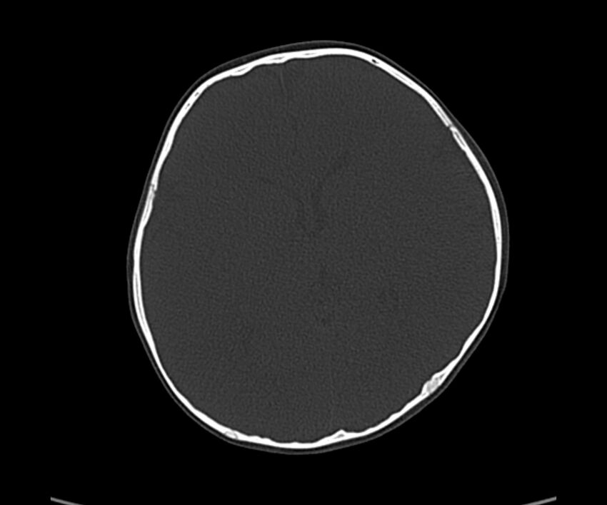 Acute hemorrhagic contusion (Radiopaedia 63660-72336 Axial bone window 36).jpg