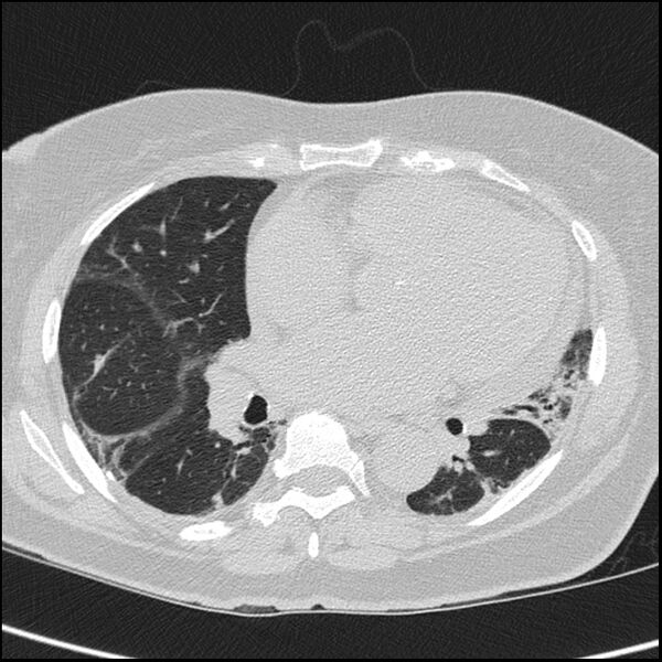 File:Acute interstitial pneumonitis (Radiopaedia 45404-49453 Axial lung window 49).jpg