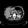 Acute myocardial infarction in CT (Radiopaedia 39947-42415 Axial C+ portal venous phase 42).jpg