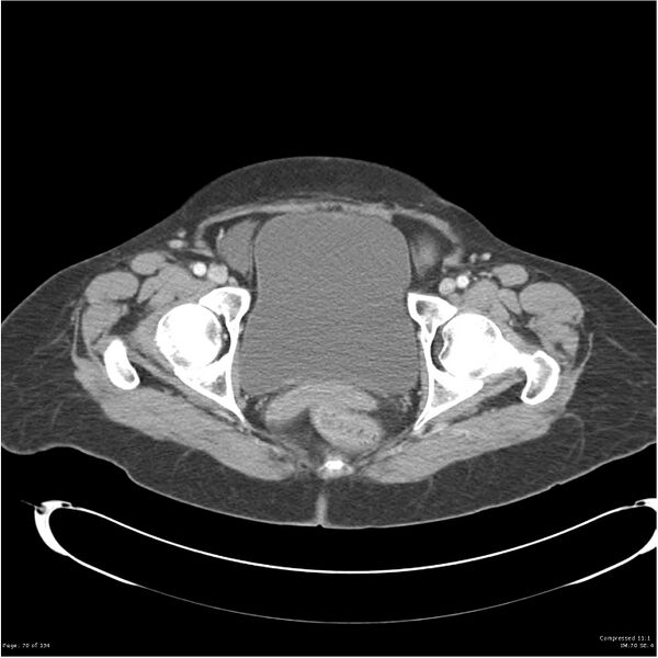 File:Acute pancreatitis (Radiopaedia 19136-19117 Axial C+ portal venous phase 41).jpg