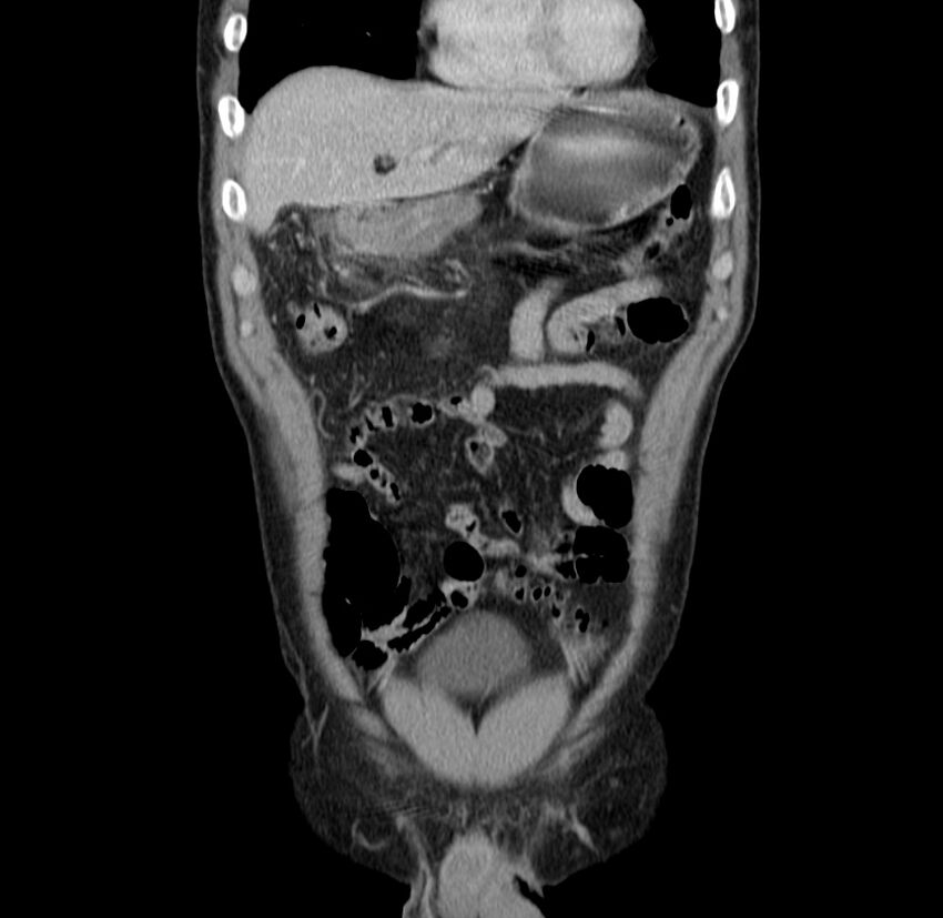Acute pancreatitis (Radiopaedia 22572-22596 Coronal C+ portal venous phase 14).jpg