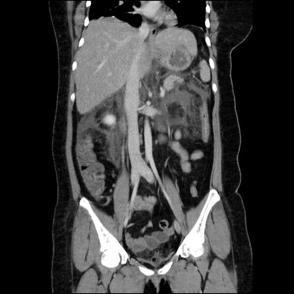 File:Acute pancreatitis (Radiopaedia 69236-79012 Coronal C+ portal venous phase 39).jpg