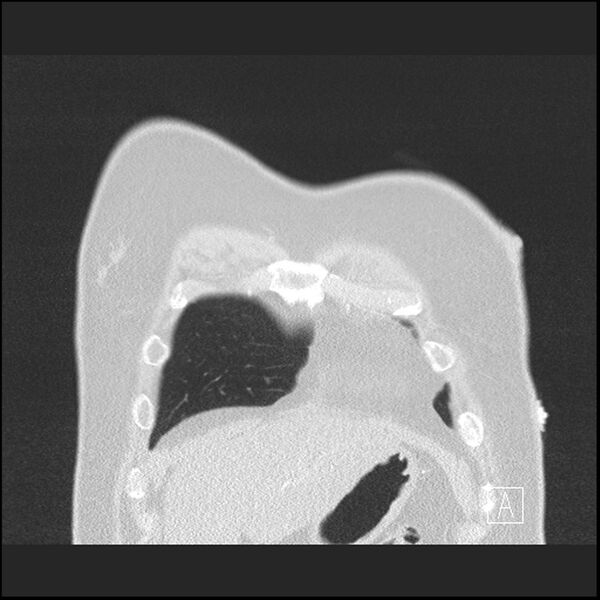 File:Acute pulmonary embolism with pulmonary infarct (Radiopaedia 73062-83768 Coronal lung window 6).jpg