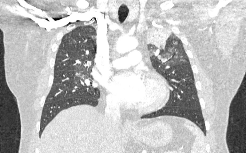 File:Acute pulmonary embolism with pulmonary infarcts (Radiopaedia 77688-89908 Coronal lung window 41).jpg