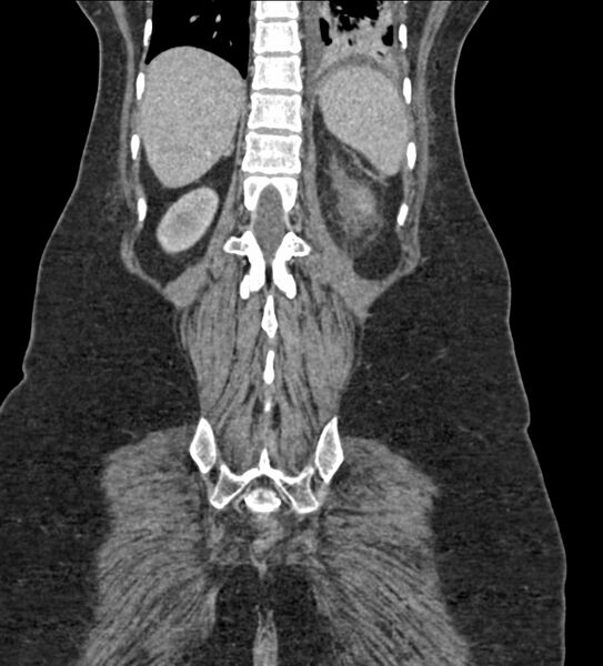 File:Acute pyelonephritis with renal vein thrombosis (Radiopaedia 58020-65053 Coronal renal parenchymal phase 109).jpg