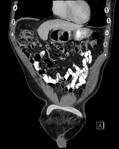 File:Acute renal infarction - rim capsular enhancement (Radiopaedia 59833-67270 Coronal C+ portal venous phase 2).jpg