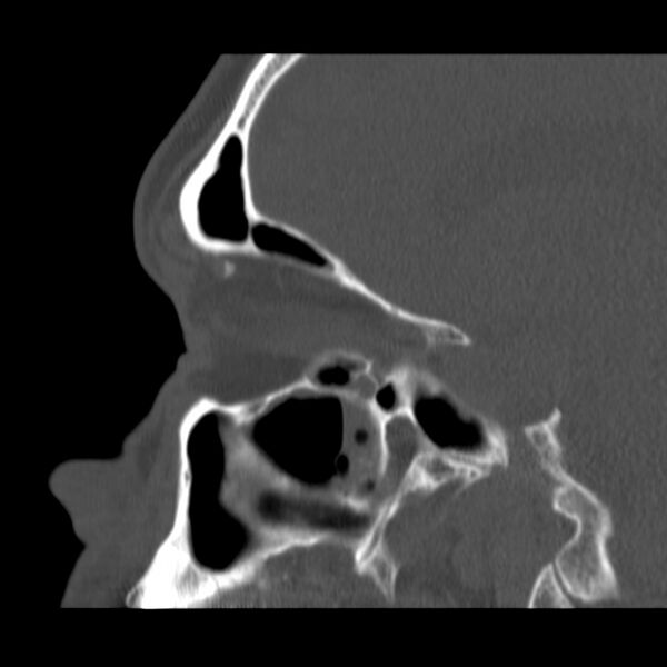 File:Acute sinusitis (Radiopaedia 23161-23215 Sagittal bone window 41).jpg
