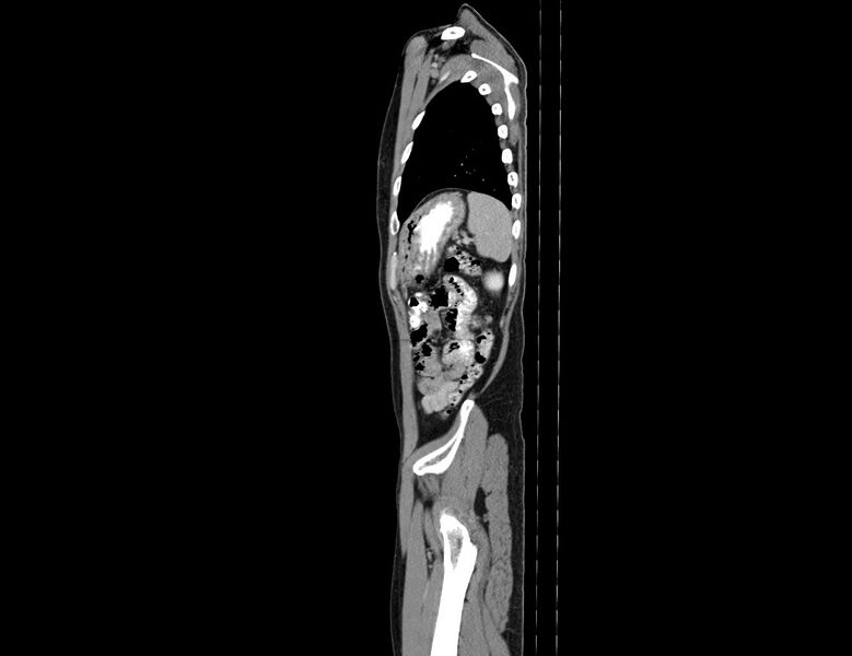 File:Addison disease (Radiopaedia 49318-54412 Sagittal C+ portal venous phase 11).jpg