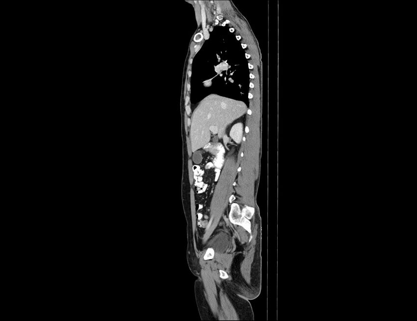Addison disease (Radiopaedia 49318-54412 Sagittal C+ portal venous phase 44).jpg