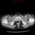 Adenocarcinoma of the colon (Radiopaedia 8191-9039 Axial renal excretory phase 65).jpg