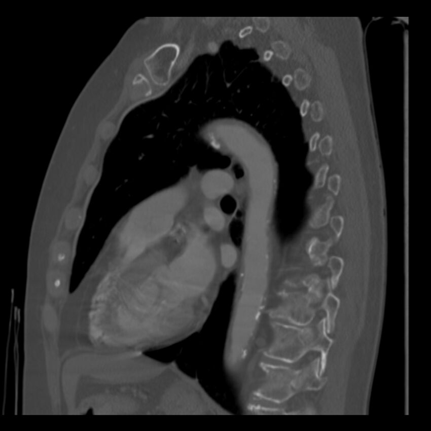 Adenocarcinoma of the lung (Radiopaedia 41015-43755 Sagittal bone window 63).jpg