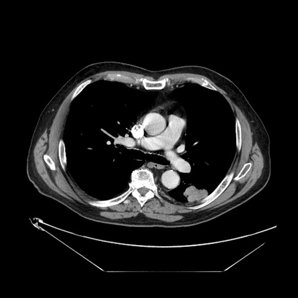 File:Adenocarcinoma of the lung (Radiopaedia 44876-48759 Axial C+ portal venous phase 38).jpg