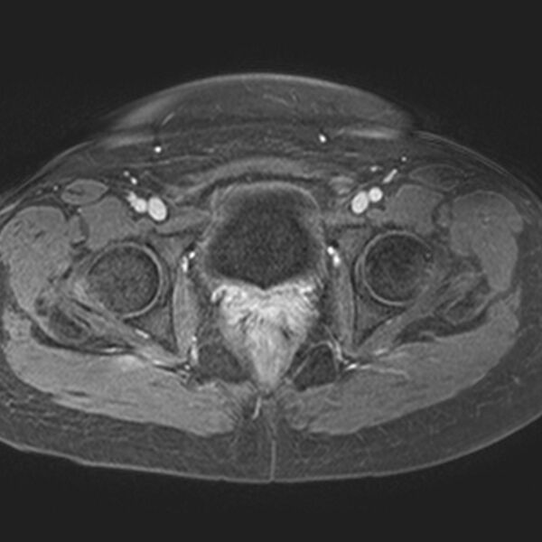 File:Adenomyoma of the uterus (Radiopaedia 9871-10439 Axial T1 C+ fat sat 6).jpg