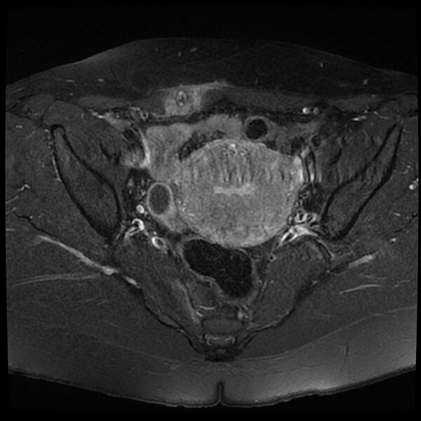File:Adenomyosis-scar endometriosis (Radiopaedia 65863-75022 Axial T1 C+ fat sat 11).jpg