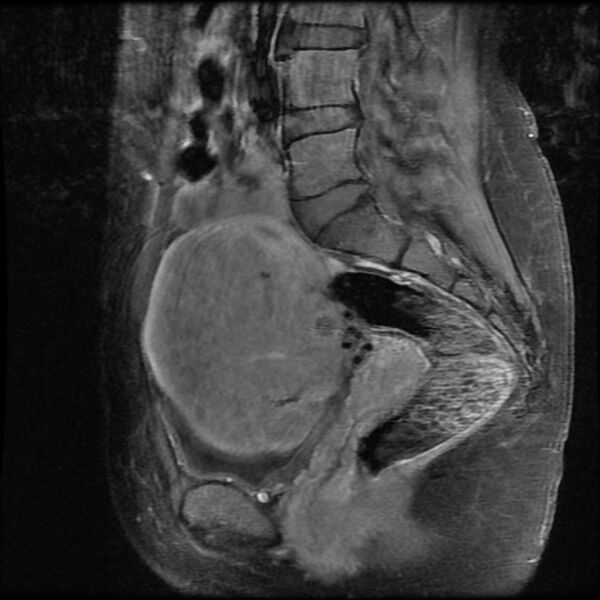 File:Adenomyosis on MRI (Radiopaedia 29328-29780 Sagittal T1 C+ fat sat 7).jpg