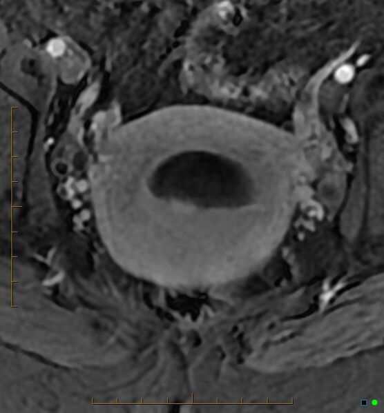 File:Adenomyosis uterus with hematometra (Radiopaedia 45779-50011 Axial T1 C+ fat sat 37).jpg