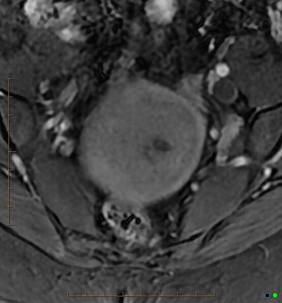 File:Adenomyosis uterus with hematometra (Radiopaedia 45779-50011 Axial T1 C+ fat sat 9).jpg