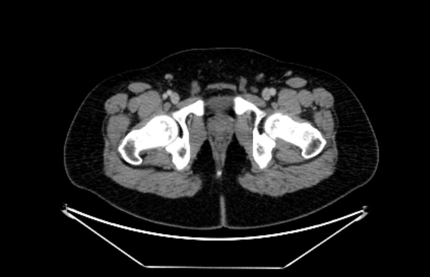 Adrenocortical carcinoma (Radiopaedia 80134-93438 Axial C+ portal venous phase 132).jpg
