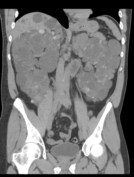 File:Adult polycystic kidney disease (Radiopaedia 47866-52626 Coronal non-contrast 25).png