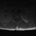 Aggressive vertebral hemangioma (Radiopaedia 39937-42404 Axial T1 9).png