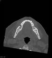 Ameloblastoma (Radiopaedia 18115-17901 Axial bone window 5).jpg