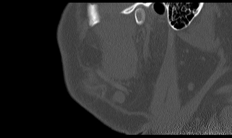 File:Ameloblastoma (Radiopaedia 33677-34806 Sagittal bone window 13).png