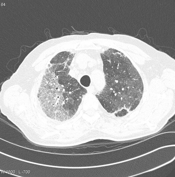 File:Amiodarone lung (Radiopaedia 6539-7851 Axial lung window 6).jpg