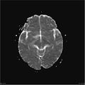 Amnestic syndrome secondary to hypoxic brain injury (Radiopaedia 24743-25004 ADC 14).jpg