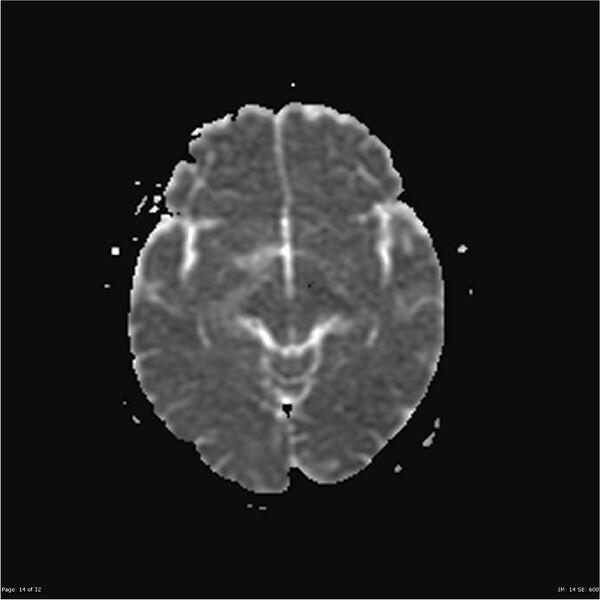 File:Amnestic syndrome secondary to hypoxic brain injury (Radiopaedia 24743-25004 ADC 14).jpg