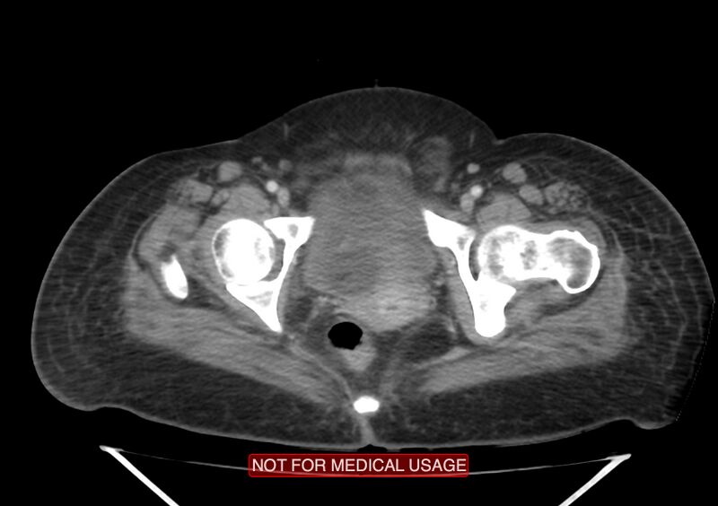File:Amoebic enterocolitis with liver abscess (Radiopaedia 35100-36609 A 79).jpg