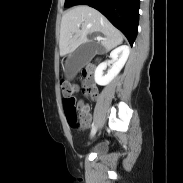 File:Ampullary tumor (Radiopaedia 22787-22816 D 20).jpg