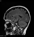 Amyotrophic lateral sclerosis (Radiopaedia 5373-7134 Sagittal FLAIR 18).jpg