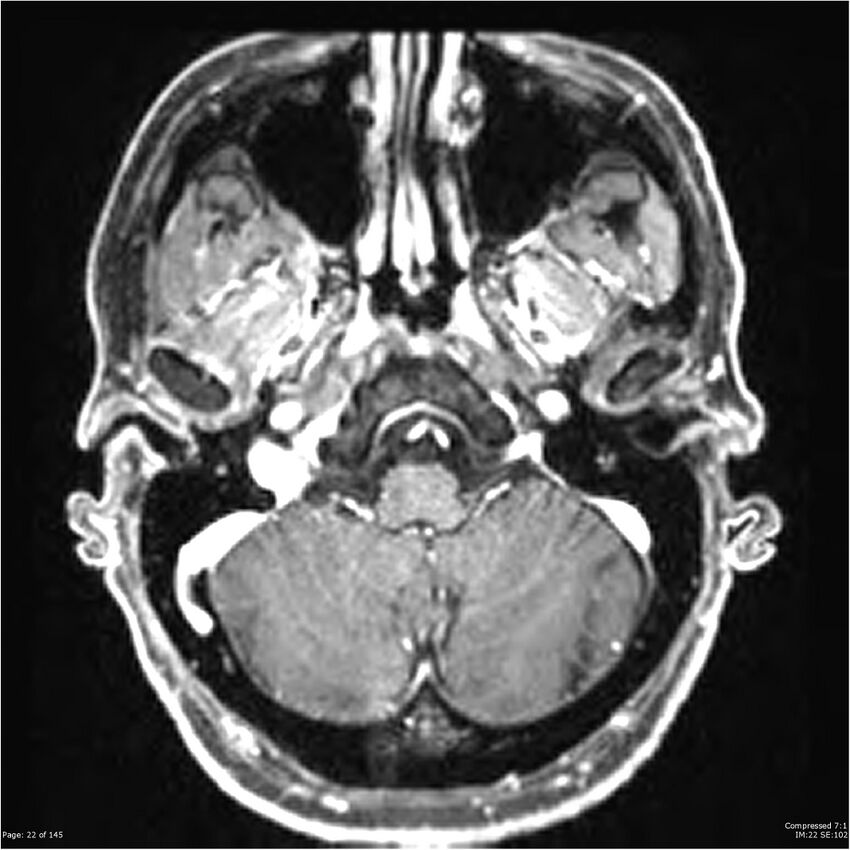 Anaplastic meningioma with recurrence (Radiopaedia 34452-35788 Axial T1 C+ 22).jpg