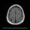 Anatomy- sulci of the brain (Radiopaedia 33834-34995 Central sulcus 4).jpg